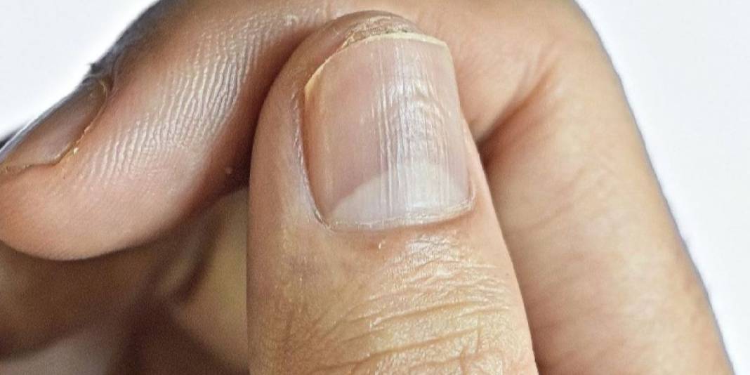 Vitamin eksikliği sandığınız çizgiler ipucu olabilir! Vitamin eksikliği mi, başka bir sorun mu? İşte cevabı… 5